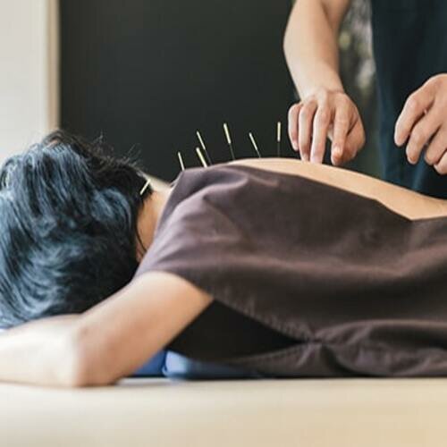 Acupuncture
